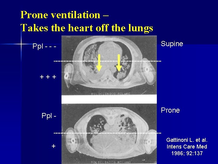 Prone ventilation – Takes the heart off the lungs Ppl - - - Supine