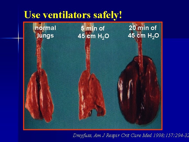 Use ventilators safely! normal lungs 5 min of 45 cm H 2 O 20