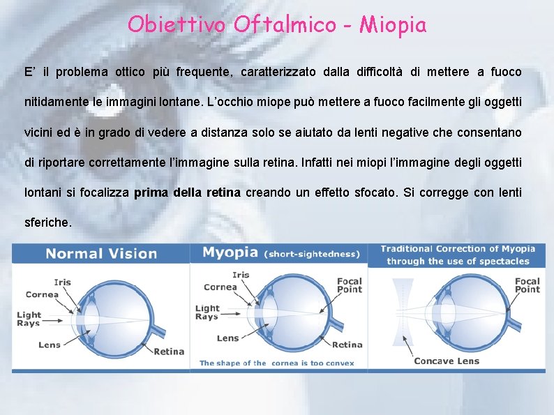 Obiettivo Oftalmico - Miopia E’ il problema ottico più frequente, caratterizzato dalla difficoltà di