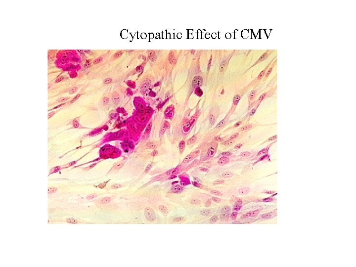 Cytopathic Effect of CMV 
