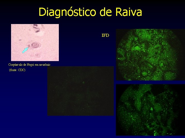 Diagnóstico de Raiva IFD Corpúsculo de Negri em neurônio (fonte: CDC) 