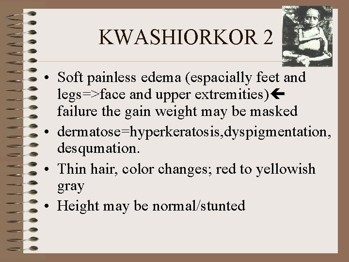 KWASHIORKOR 2 • Soft painless edema (espacially feet and legs=>face and upper extremities) failure