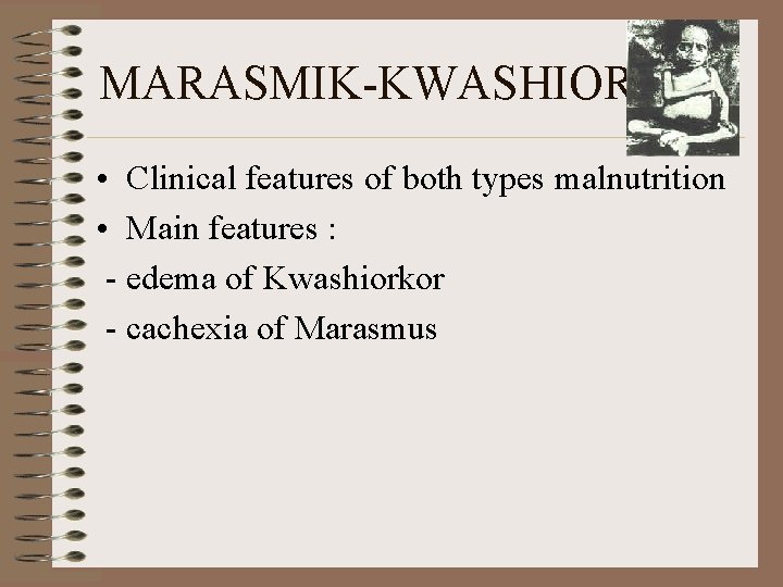 MARASMIK-KWASHIORKOR • Clinical features of both types malnutrition • Main features : - edema