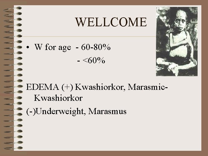 WELLCOME • W for age - 60 -80% - <60% EDEMA (+) Kwashiorkor, Marasmic-