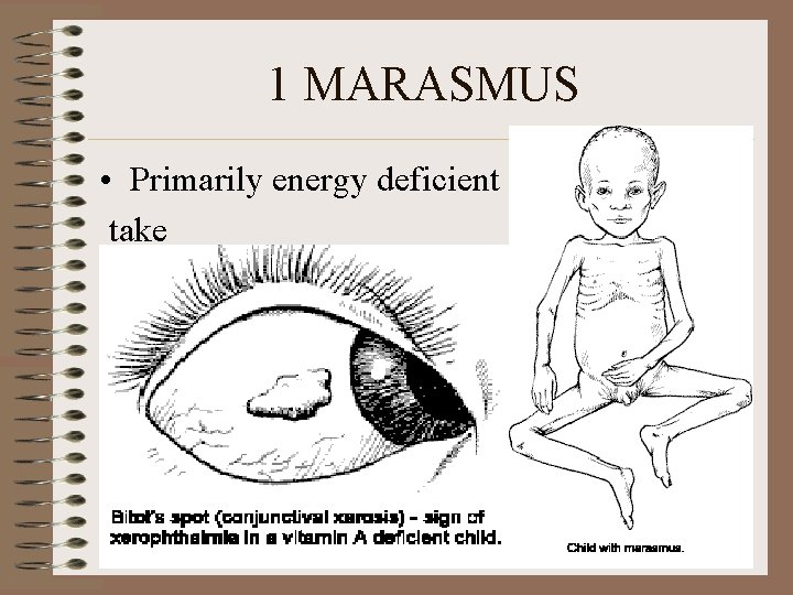 1 MARASMUS • Primarily energy deficient take 