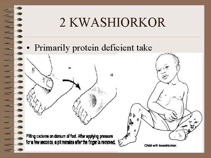 2 KWASHIORKOR • Primarily protein deficient take 