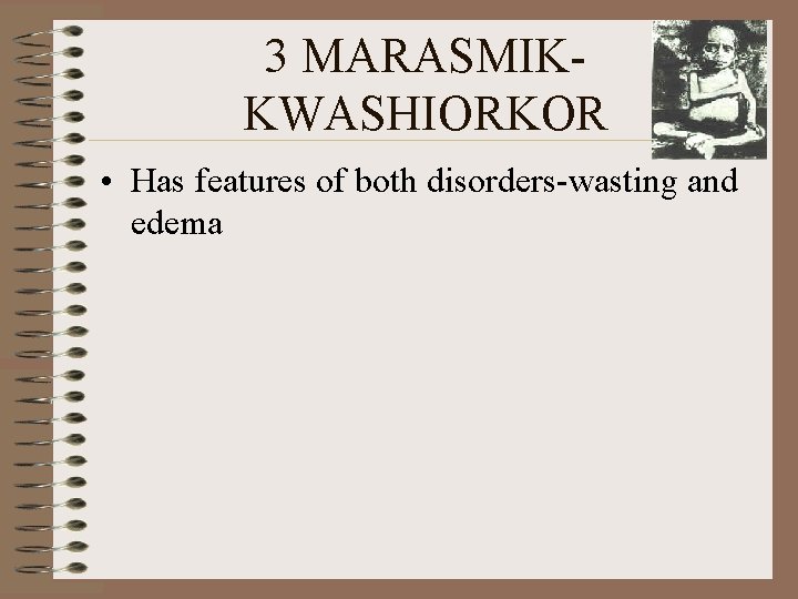 3 MARASMIKKWASHIORKOR • Has features of both disorders-wasting and edema 
