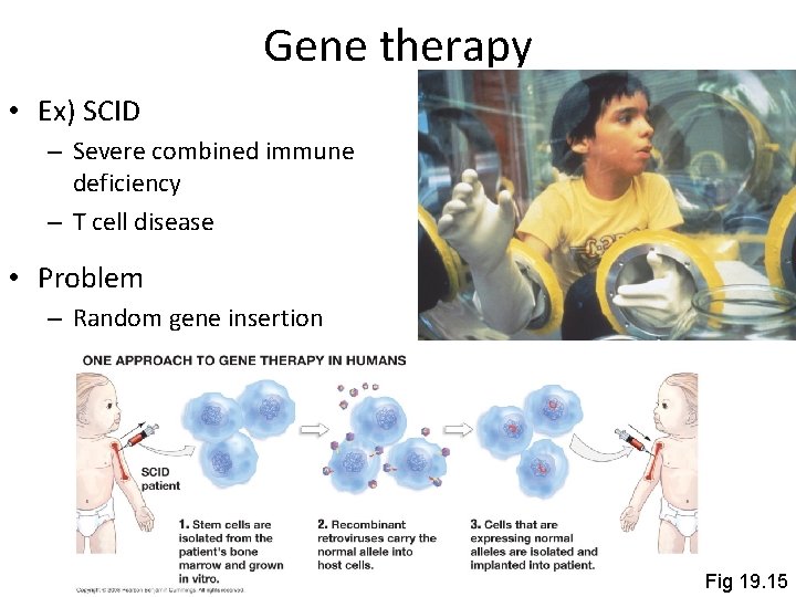 Gene therapy • Ex) SCID – Severe combined immune deficiency – T cell disease