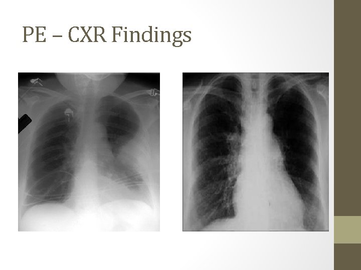 PE – CXR Findings 