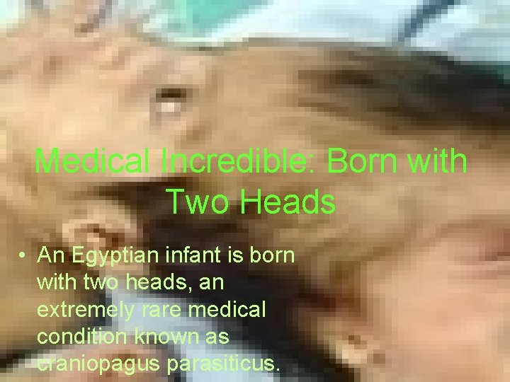 Medical Incredible: Born with Two Heads • An Egyptian infant is born with two