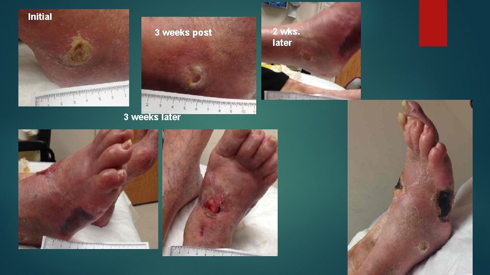 Initial 3 weeks post 3 weeks later 2 wks. later Initial 3 weeks post 3 weeks later 2 wks. later