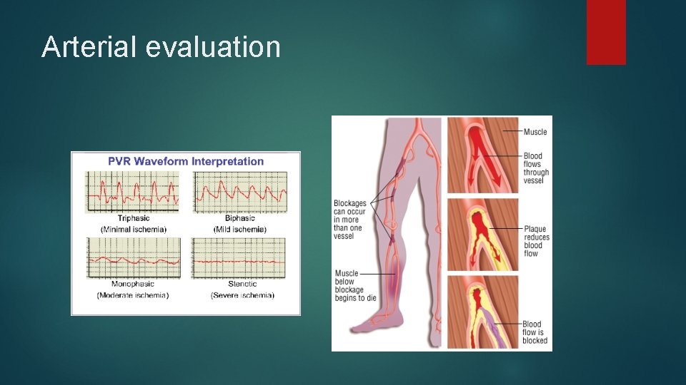 Arterial evaluation 