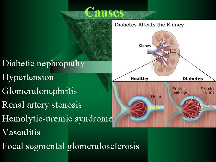 Causes Diabetic nephropathy Hypertension Glomerulonephritis Renal artery stenosis Hemolytic-uremic syndrome Vasculitis Focal segmental glomerulosclerosis