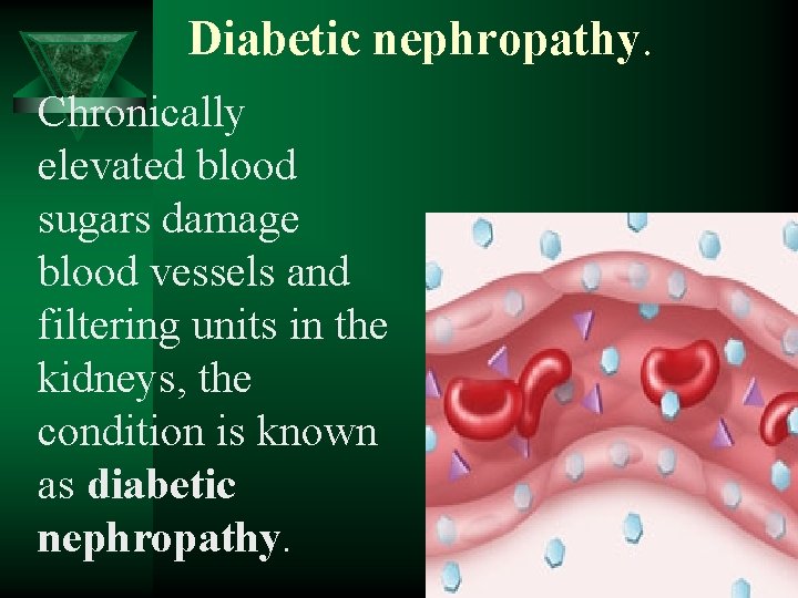 Diabetic nephropathy. Chronically elevated blood sugars damage blood vessels and filtering units in the