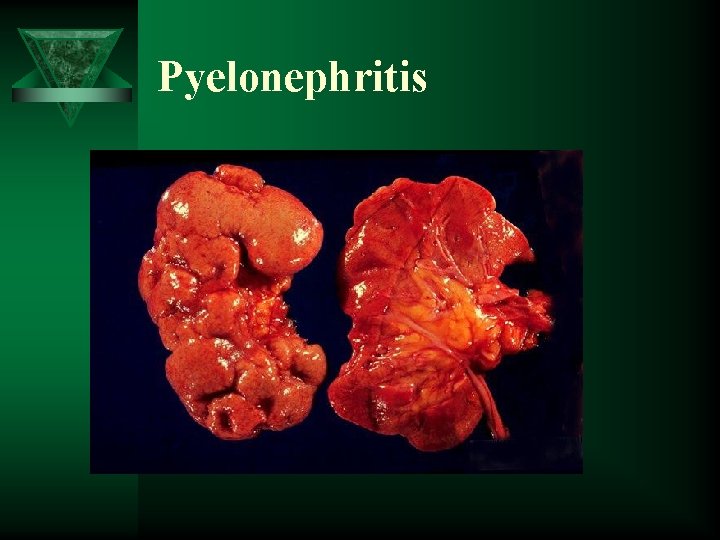Pyelonephritis 
