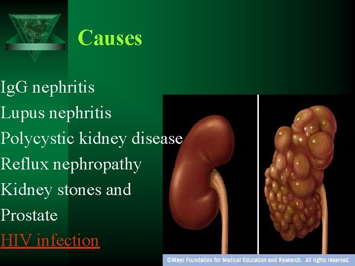 Causes Ig. G nephritis Lupus nephritis Polycystic kidney disease Reflux nephropathy Kidney stones and