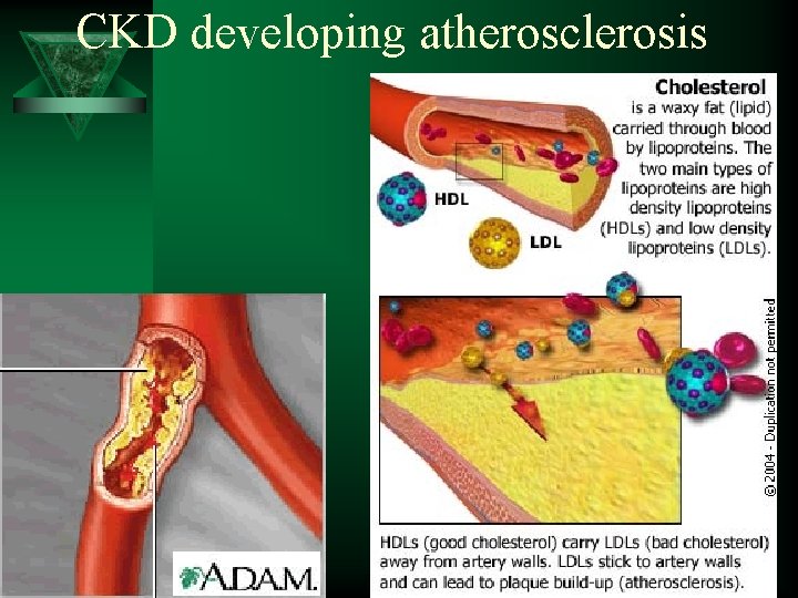 CKD developing atherosclerosis 