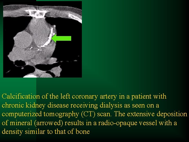 Calcification of the left coronary artery in a patient with chronic kidney disease receiving