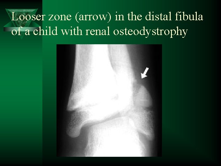 Looser zone (arrow) in the distal fibula of a child with renal osteodystrophy 