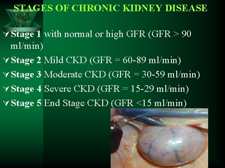 STAGES OF CHRONIC KIDNEY DISEASE Ú Stage 1 with normal or high GFR (GFR