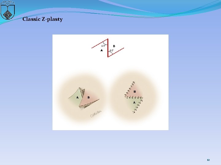 Classic Z-plasty 12 
