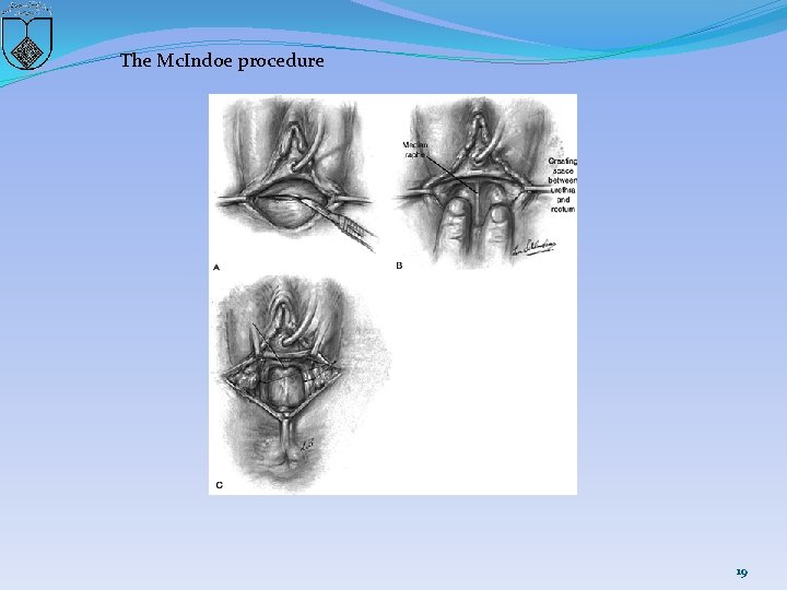 The Mc. Indoe procedure 19 