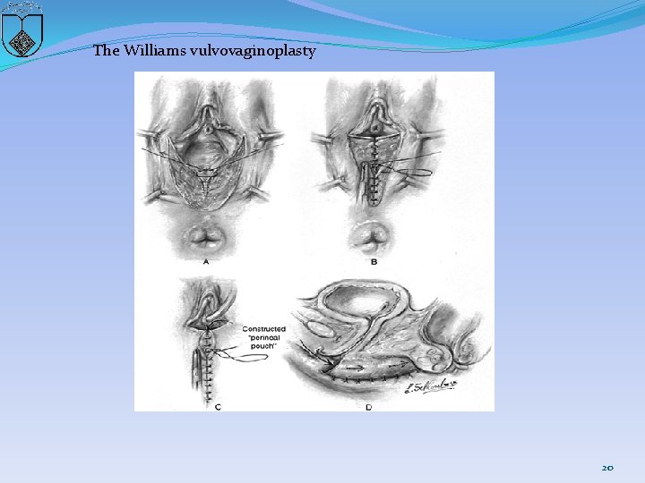 The Williams vulvovaginoplasty 20 