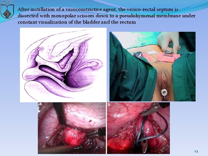 After instillation of a vasoconstrictive agent, the vesico-rectal septum is dissected with monopolar scissors