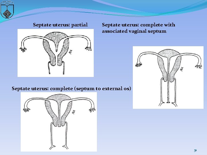 Septate uterus: partial Septate uterus: complete with associated vaginal septum Septate uterus: complete (septum