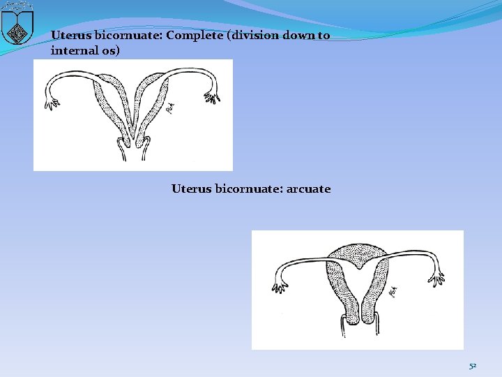 Uterus bicornuate: Complete (division down to internal os) Uterus bicornuate: arcuate 52 
