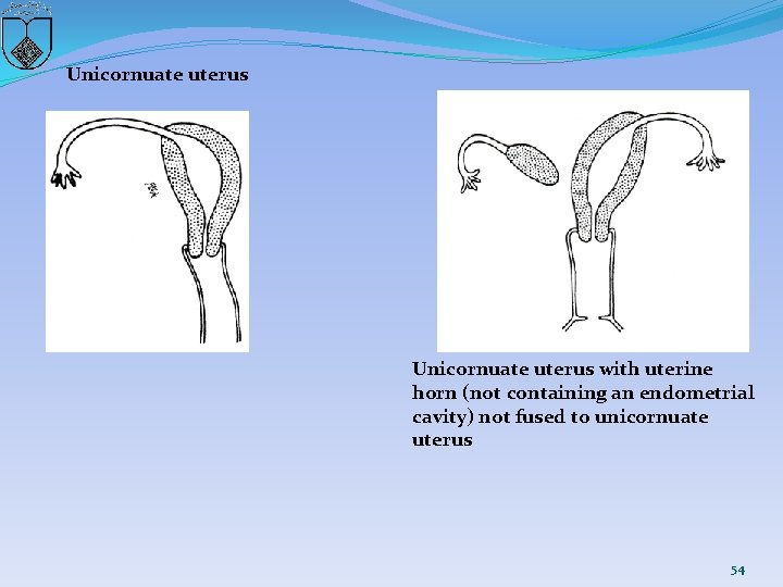 Unicornuate uterus with uterine horn (not containing an endometrial cavity) not fused to unicornuate