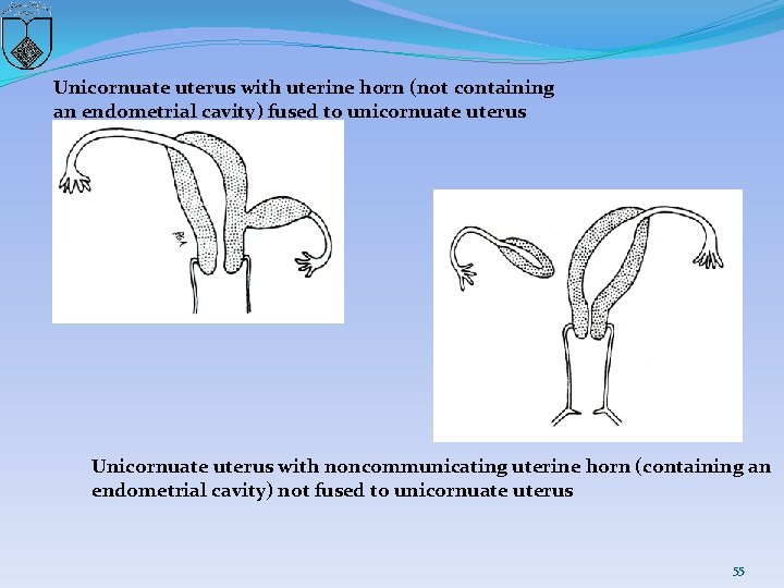 Unicornuate uterus with uterine horn (not containing an endometrial cavity) fused to unicornuate uterus