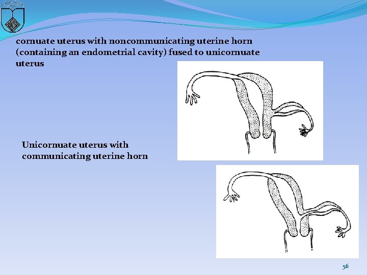 cornuate uterus with noncommunicating uterine horn (containing an endometrial cavity) fused to unicornuate uterus