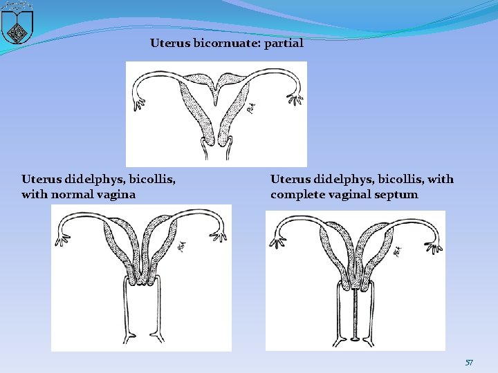 Uterus bicornuate: partial Uterus didelphys, bicollis, with normal vagina Uterus didelphys, bicollis, with complete