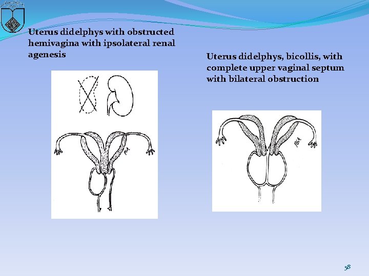 Uterus didelphys with obstructed hemivagina with ipsolateral renal agenesis Uterus didelphys, bicollis, with complete