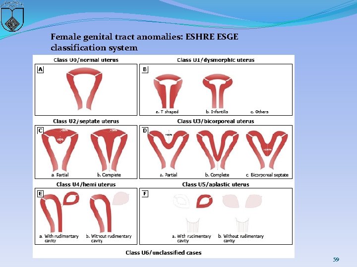 Female genital tract anomalies: ESHRE ESGE classification system 59 