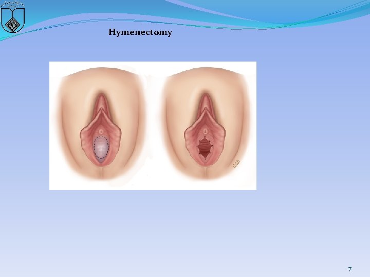 Hymenectomy 7 