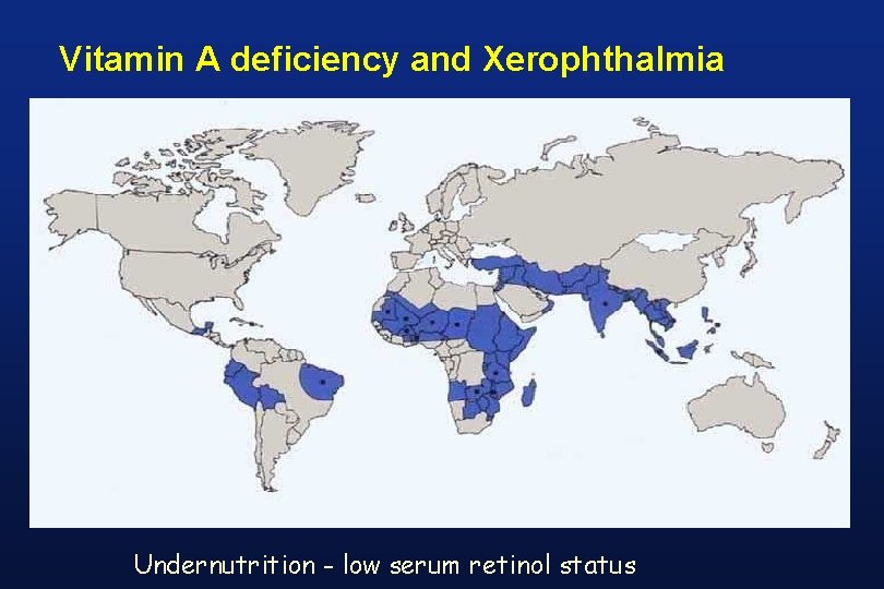 Vitamin A deficiency and Xerophthalmia Undernutrition - low serum retinol status 