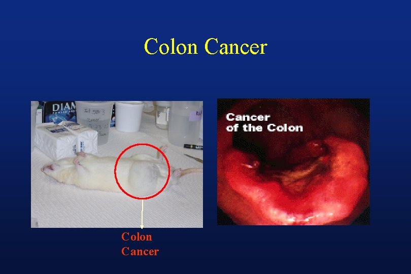 Colon Cancer 