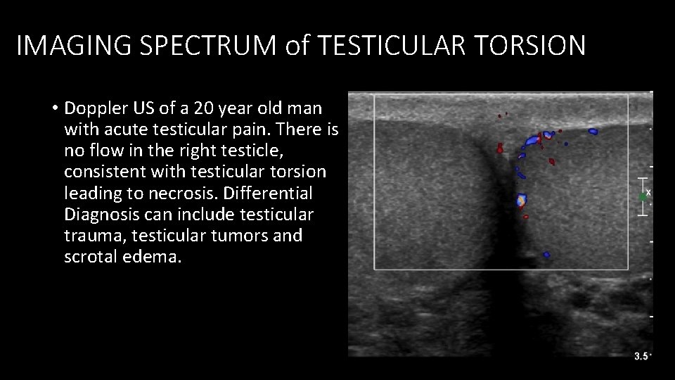IMAGING SPECTRUM of TESTICULAR TORSION • Doppler US of a 20 year old man