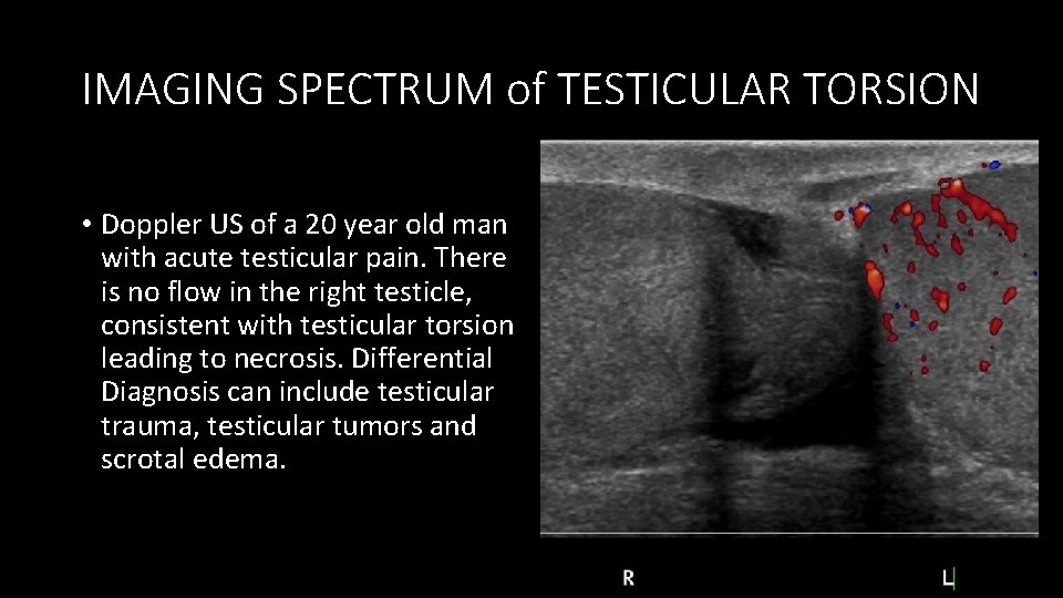 IMAGING SPECTRUM of TESTICULAR TORSION • Doppler US of a 20 year old man