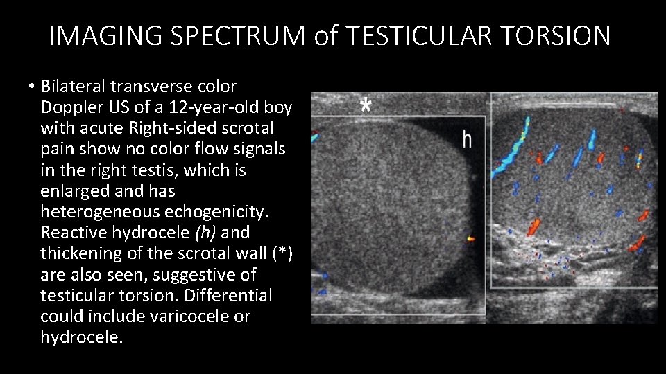 IMAGING SPECTRUM of TESTICULAR TORSION • Bilateral transverse color Doppler US of a 12