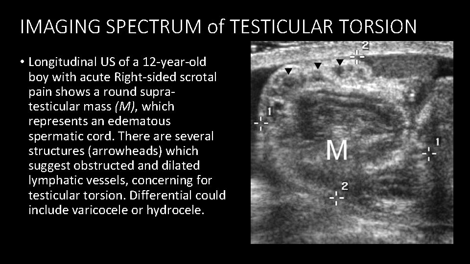IMAGING SPECTRUM of TESTICULAR TORSION • Longitudinal US of a 12 -year-old boy with