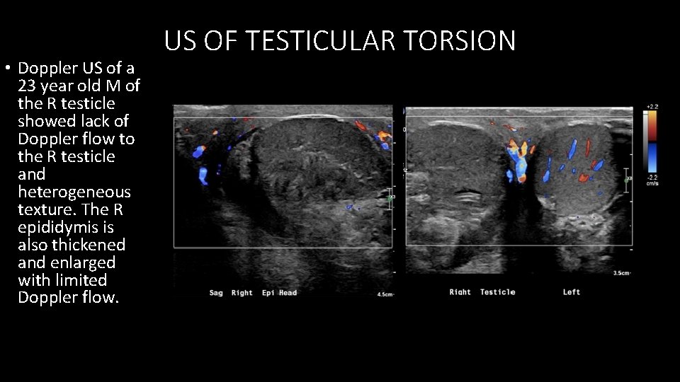  • Doppler US of a 23 year old M of the R testicle