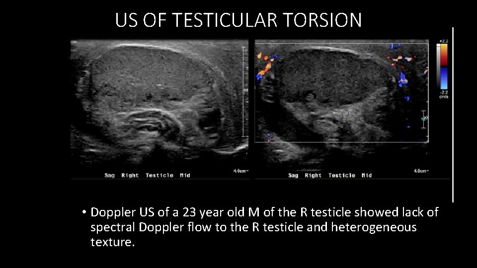 US OF TESTICULAR TORSION • Doppler US of a 23 year old M of