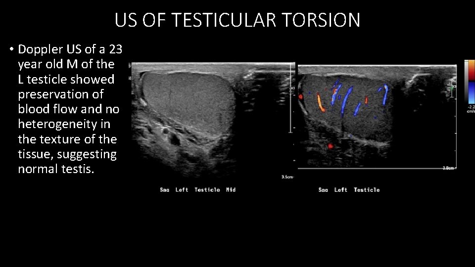 US OF TESTICULAR TORSION • Doppler US of a 23 year old M of