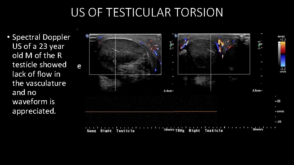US OF TESTICULAR TORSION • Spectral Doppler US of a 23 year old M
