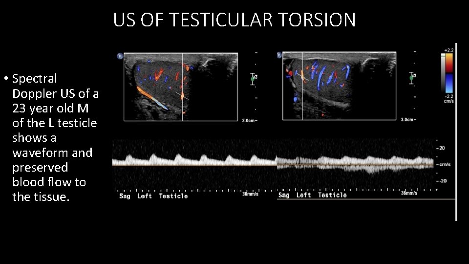 US OF TESTICULAR TORSION • Spectral Doppler US of a 23 year old M