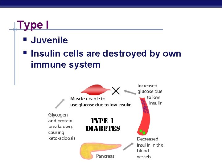 Type I § Juvenile § Insulin cells are destroyed by own immune system 