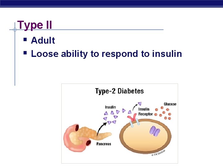 Type II § Adult § Loose ability to respond to insulin 